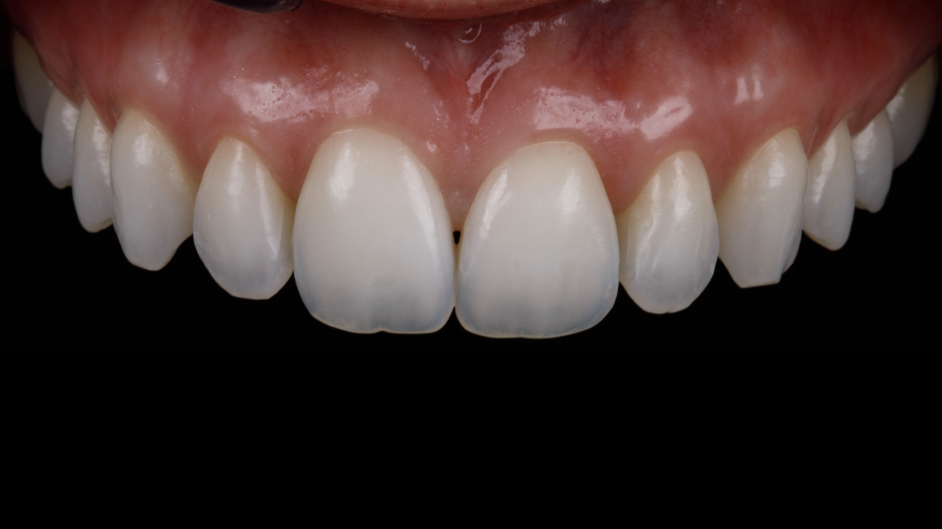 Fotografia dos dentes anteriores com fundo preto