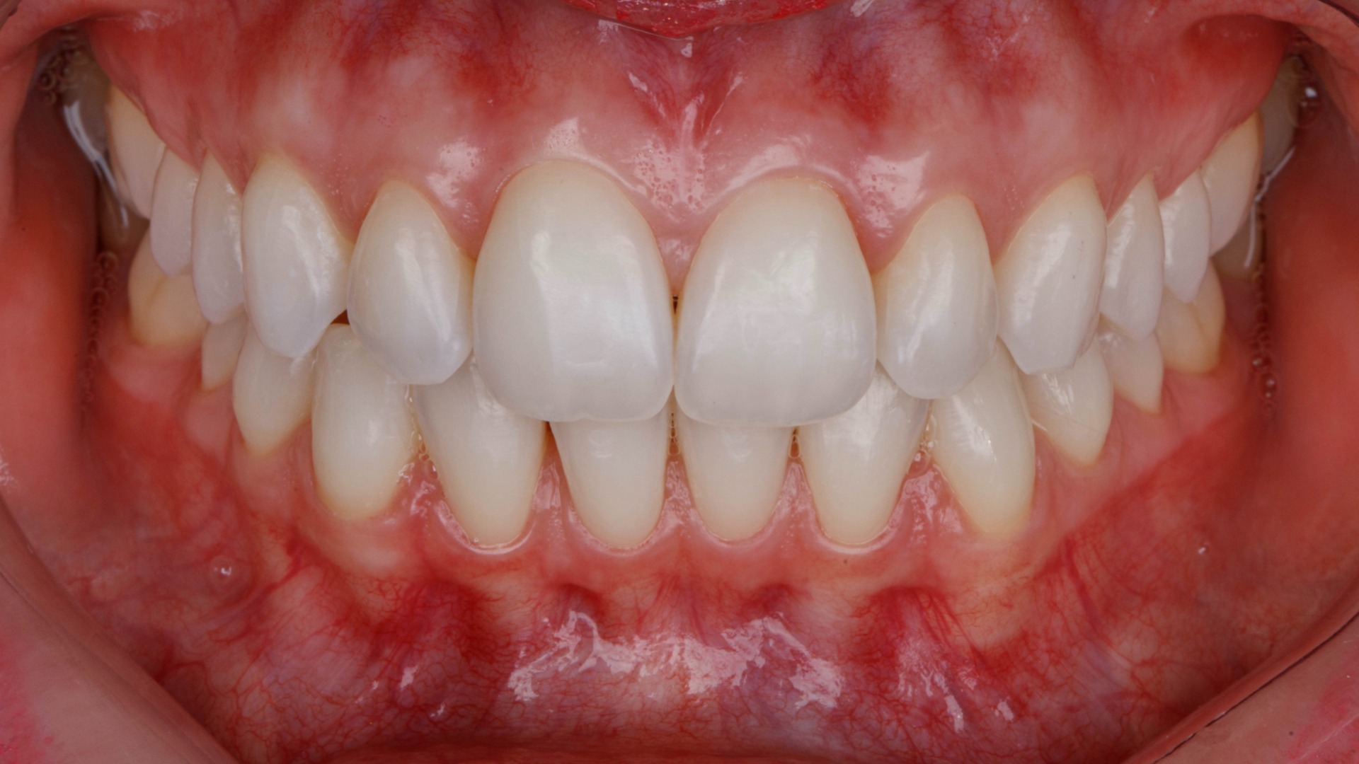 Fotografia intraoral frontal