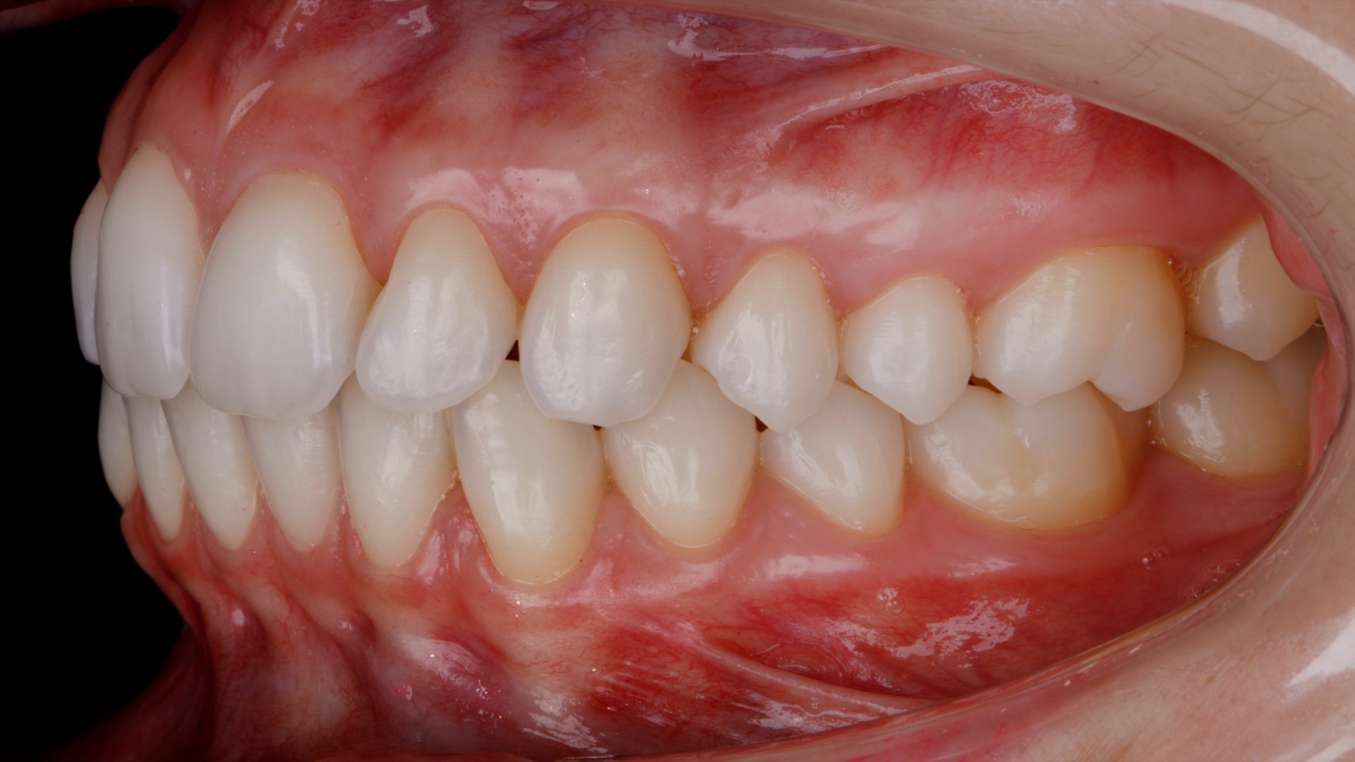 Fotografia intraoral lateral