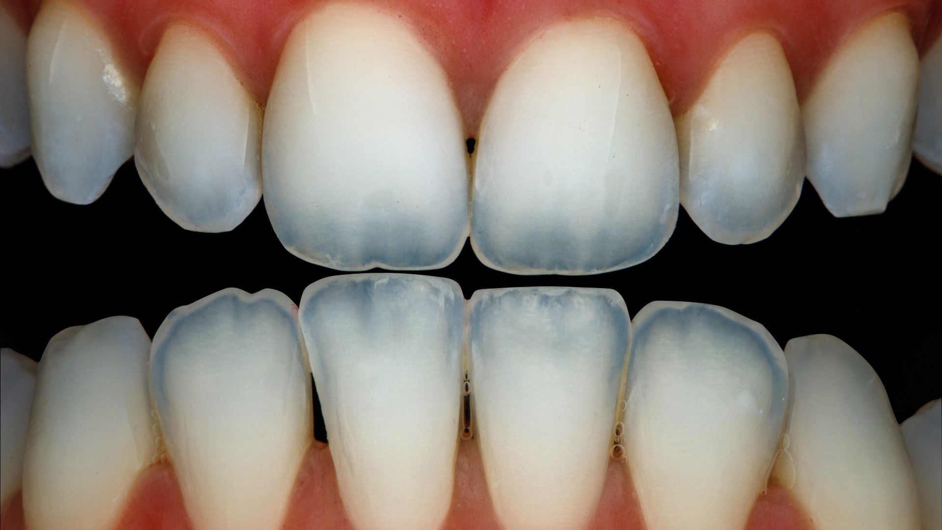 Fotografia polarizada dos dentes anteriores