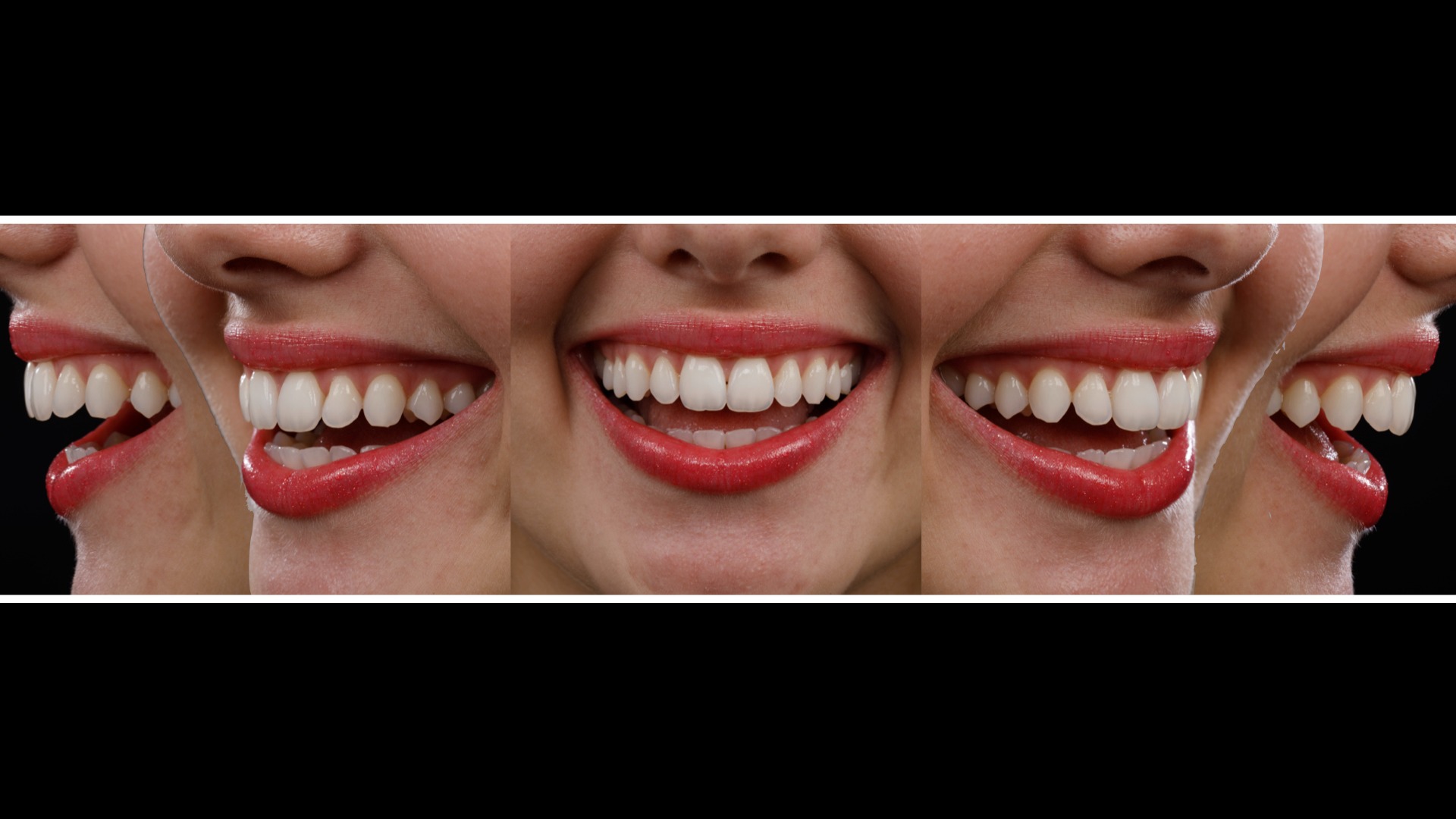 Sequência de diferentes ângulos do sorriso no protocolo fotográfico facial